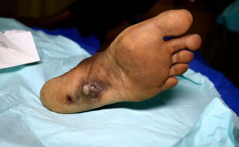 قدم مريض سوداني مصاب بالمايستوما 
