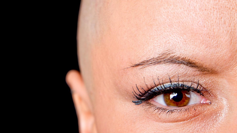 سرطان الثدي