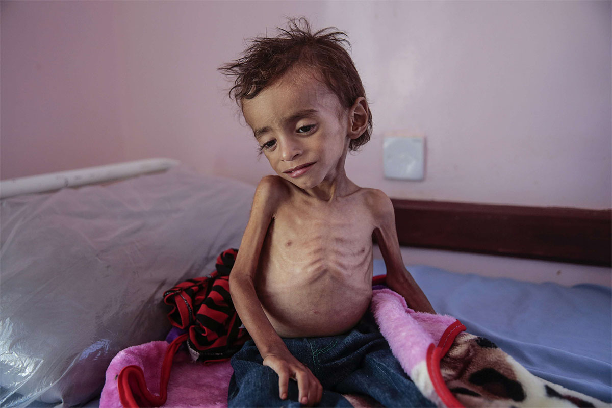 A malnourished boy sits on a hospital bed at the Aslam Health Center, Hajjah, Yemen