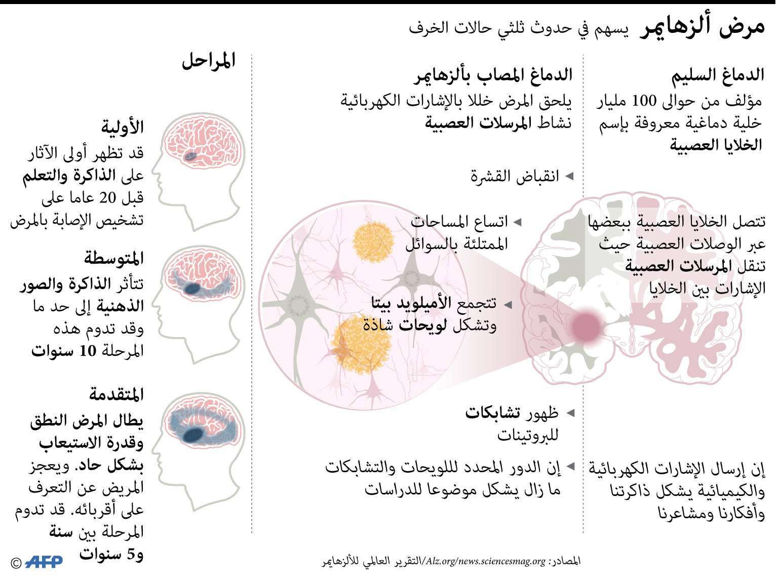 الخرف