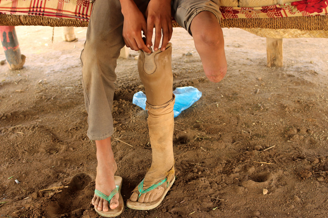 Ismail Abdullah, 12, who lost his leg in an air strike two years ago, sits in his hut at a camp for internally displaced people in Khamis of Hodeidah province