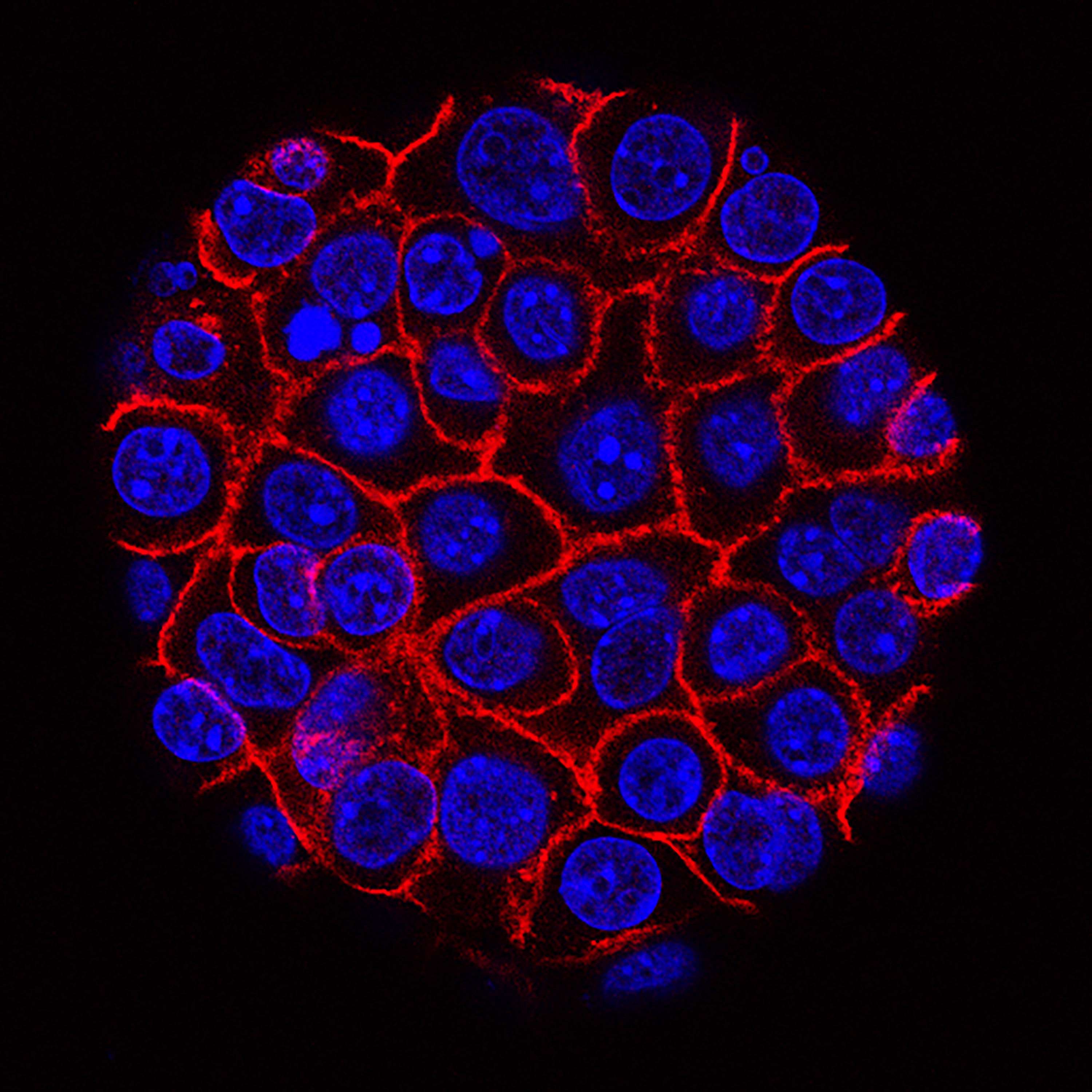 خلايا سرطانية