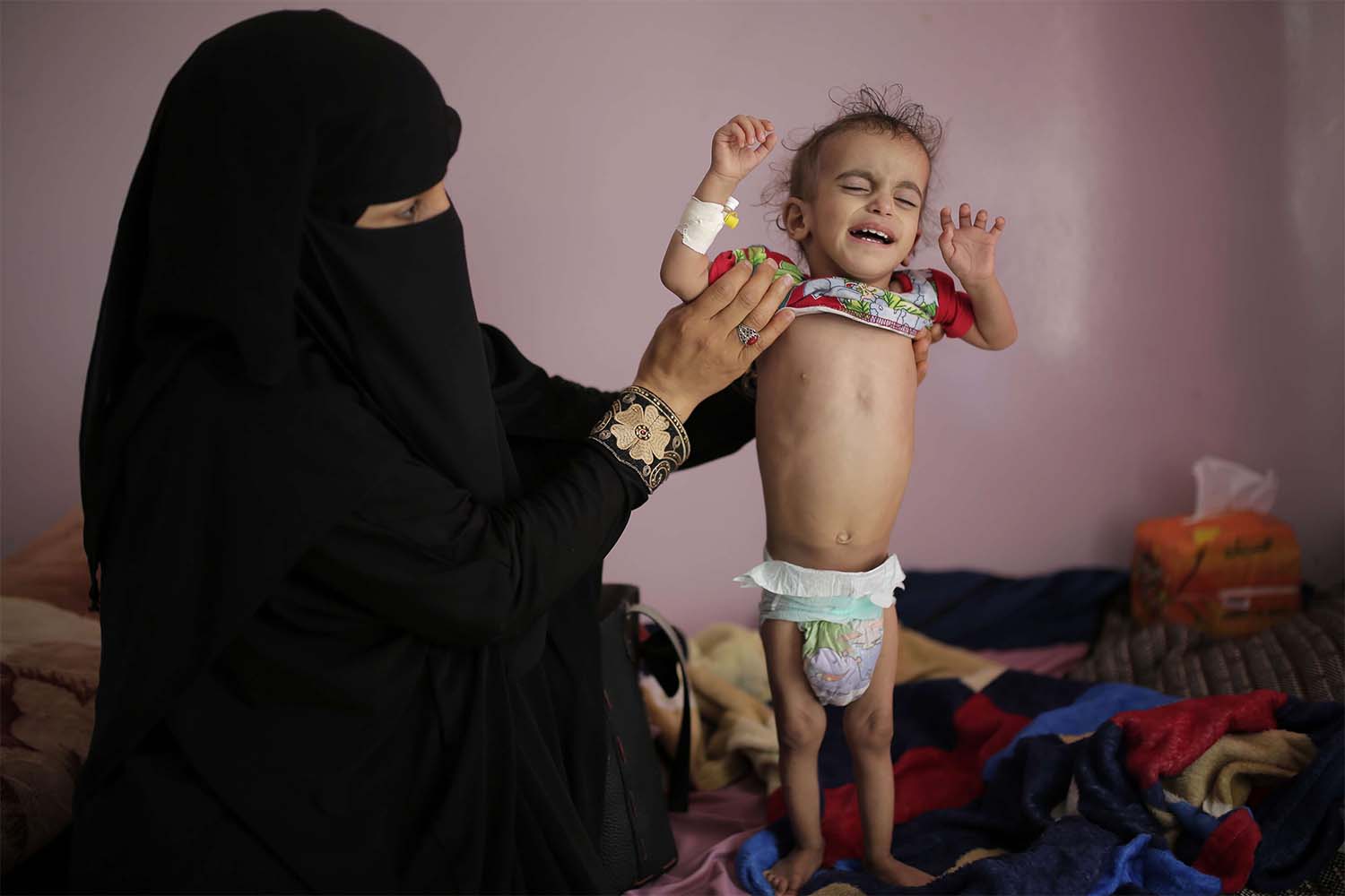 A woman holds her malnourished boy at a feeding center at Al-Sabeen hospital in Sanaa
