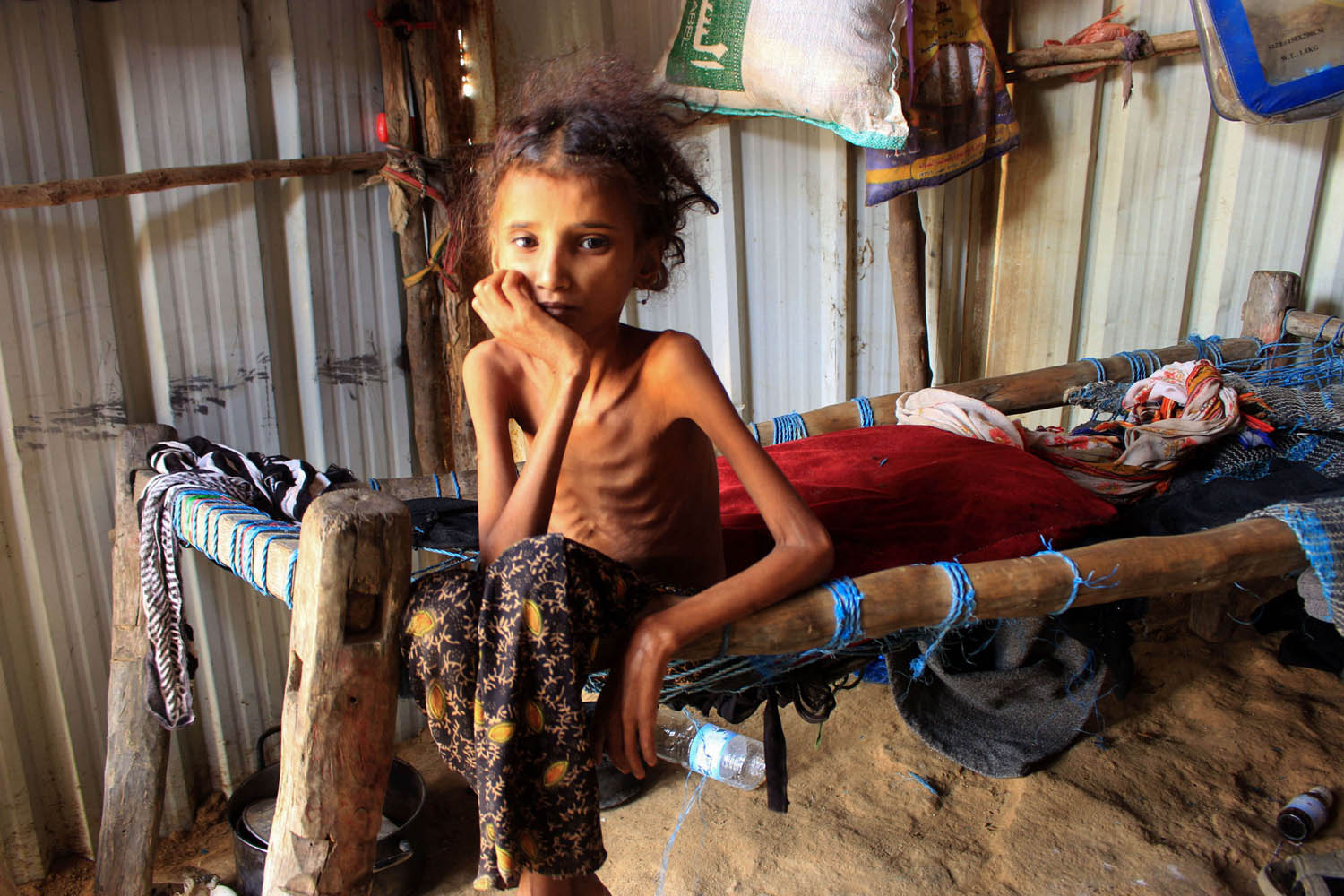 طفلة يمنية تعاني من نقص التغذية في محافظة حجة