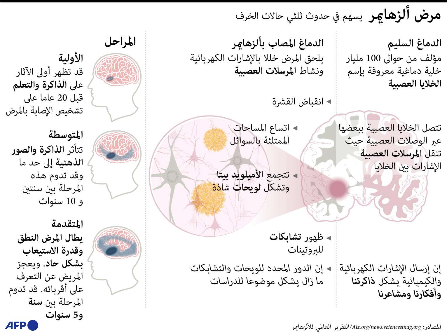 الزهايمر