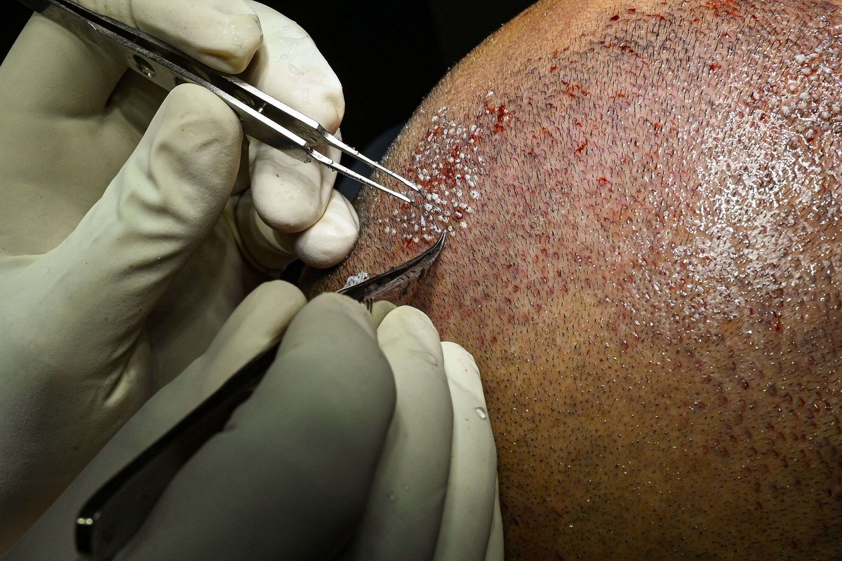 زراعة الشعر