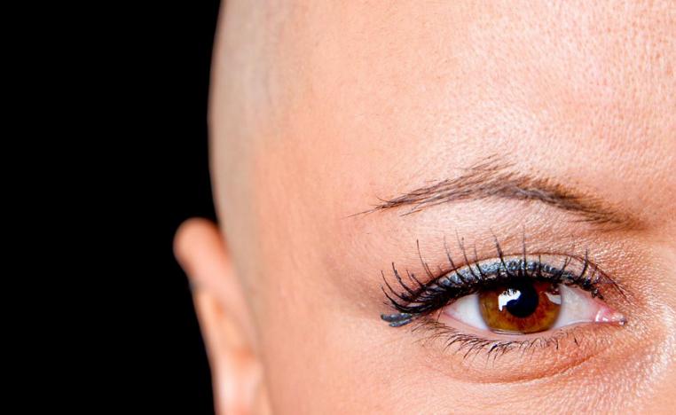 سرطان الثدي