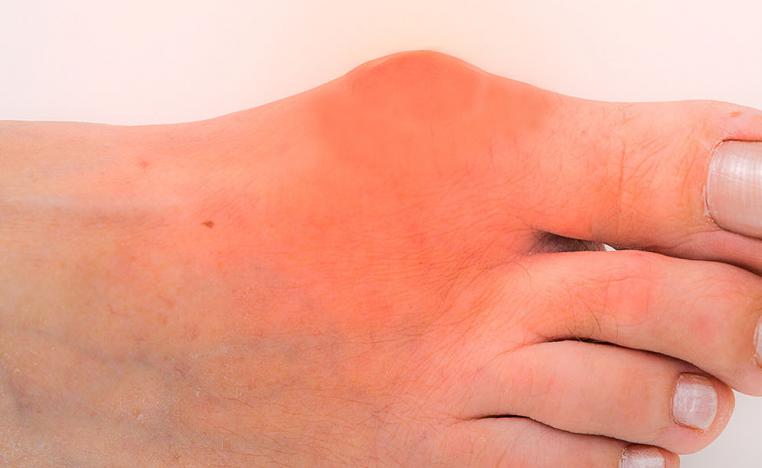 قدم مريض بالنقرس