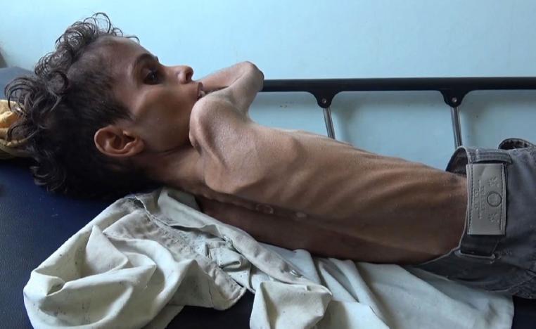 10 year-old Ghazi Saleh lies on a bed at Al-Mudhafar hospital in Taez on November 19, 2018.