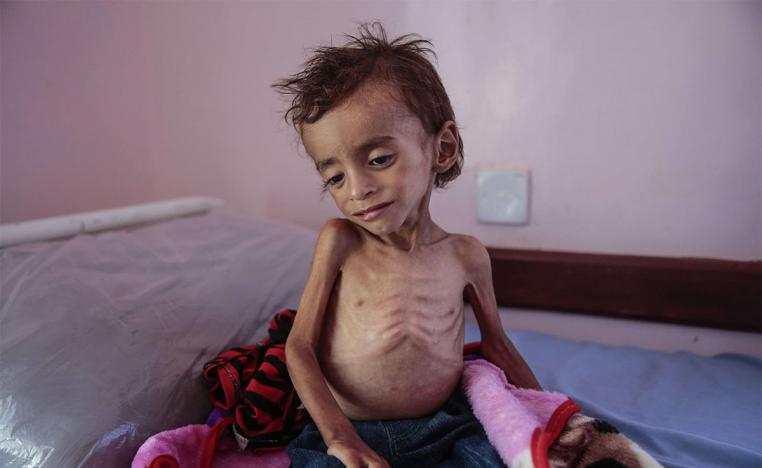 A malnourished boy sits on a hospital bed at the Aslam Health Center, Hajjah, Yemen