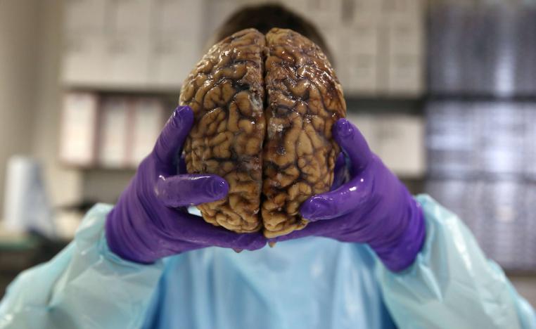 التصلب العصبي المتعدد