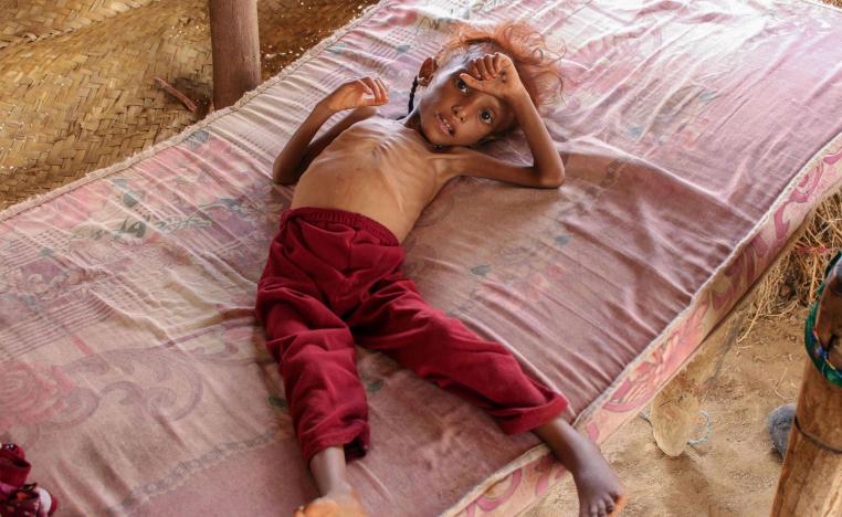 سوء التغذية