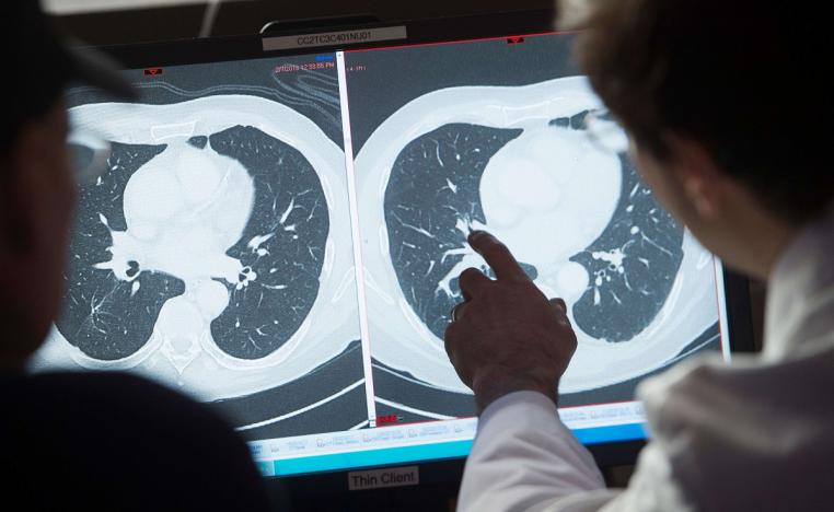 طبيب ينظر إلى صور أشعة لغدد ليمفاوية مصابة بالسرطان