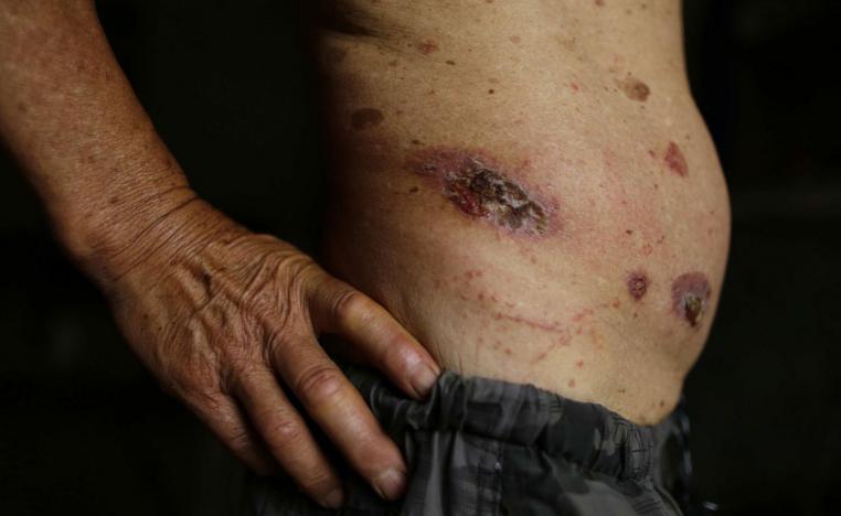 مصاب بسرطان الجلد 