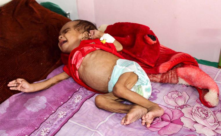 120,000 children are severely malnourished