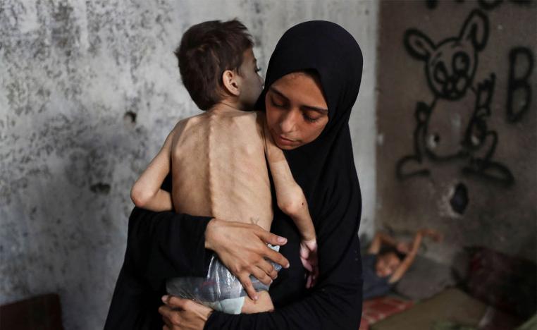 A malnourished child