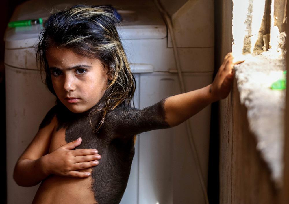 شامة عملاقة على جسد طفلة عراقية