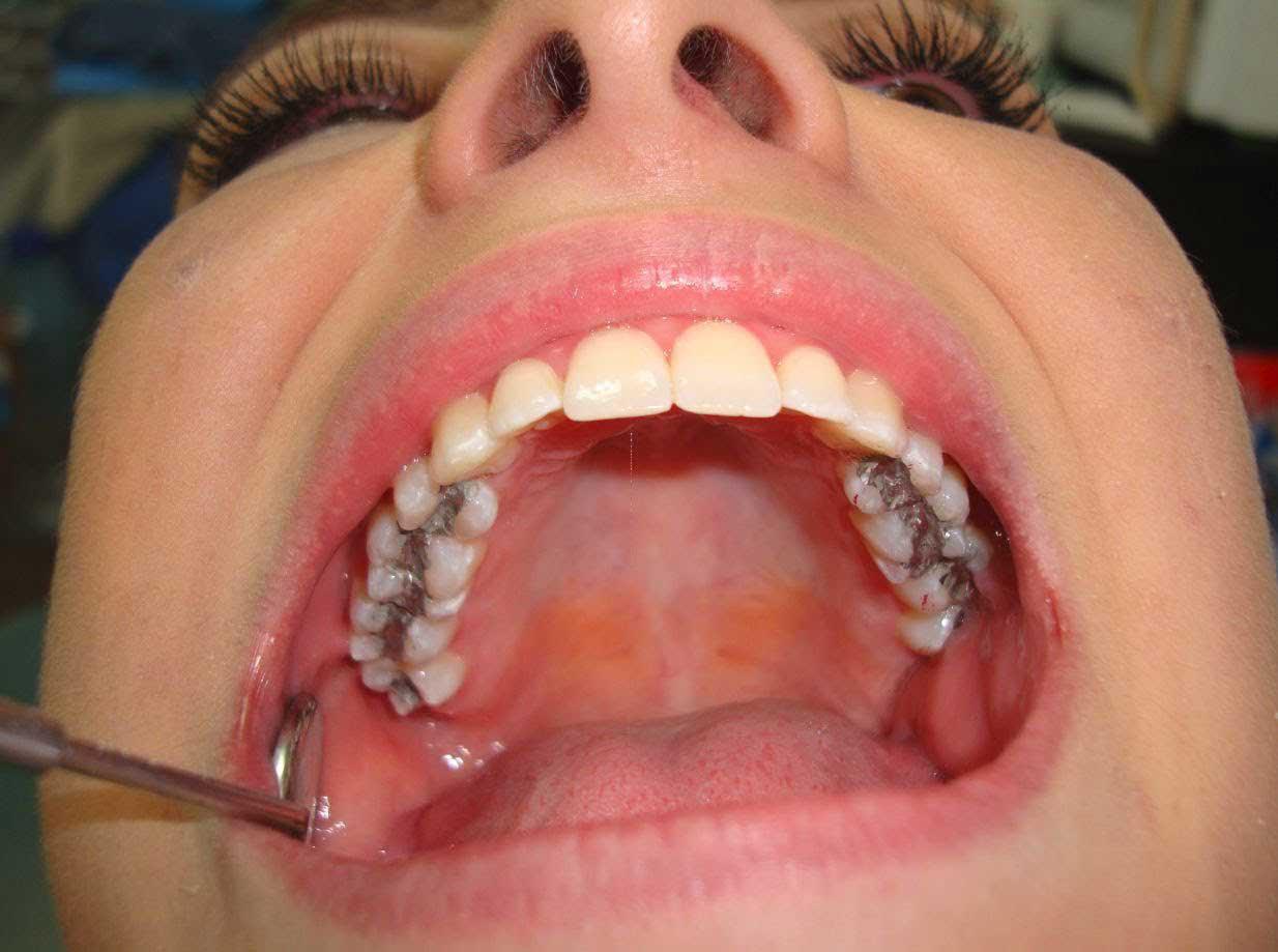 مريضة تفتح فمها في عيادة أسنان