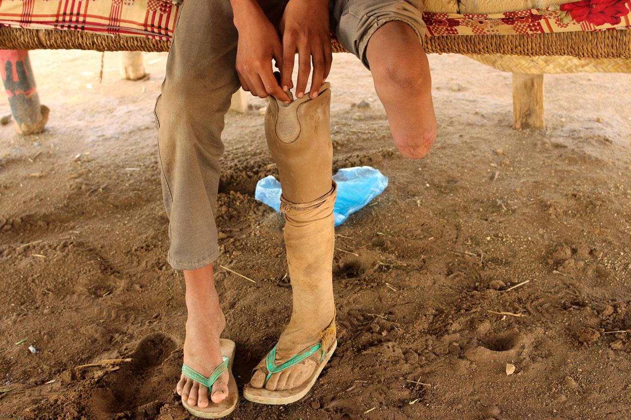 Ismail Abdullah, 12, who lost his leg in an air strike two years ago, sits in his hut at a camp for internally displaced people in Khamis of Hodeidah province
