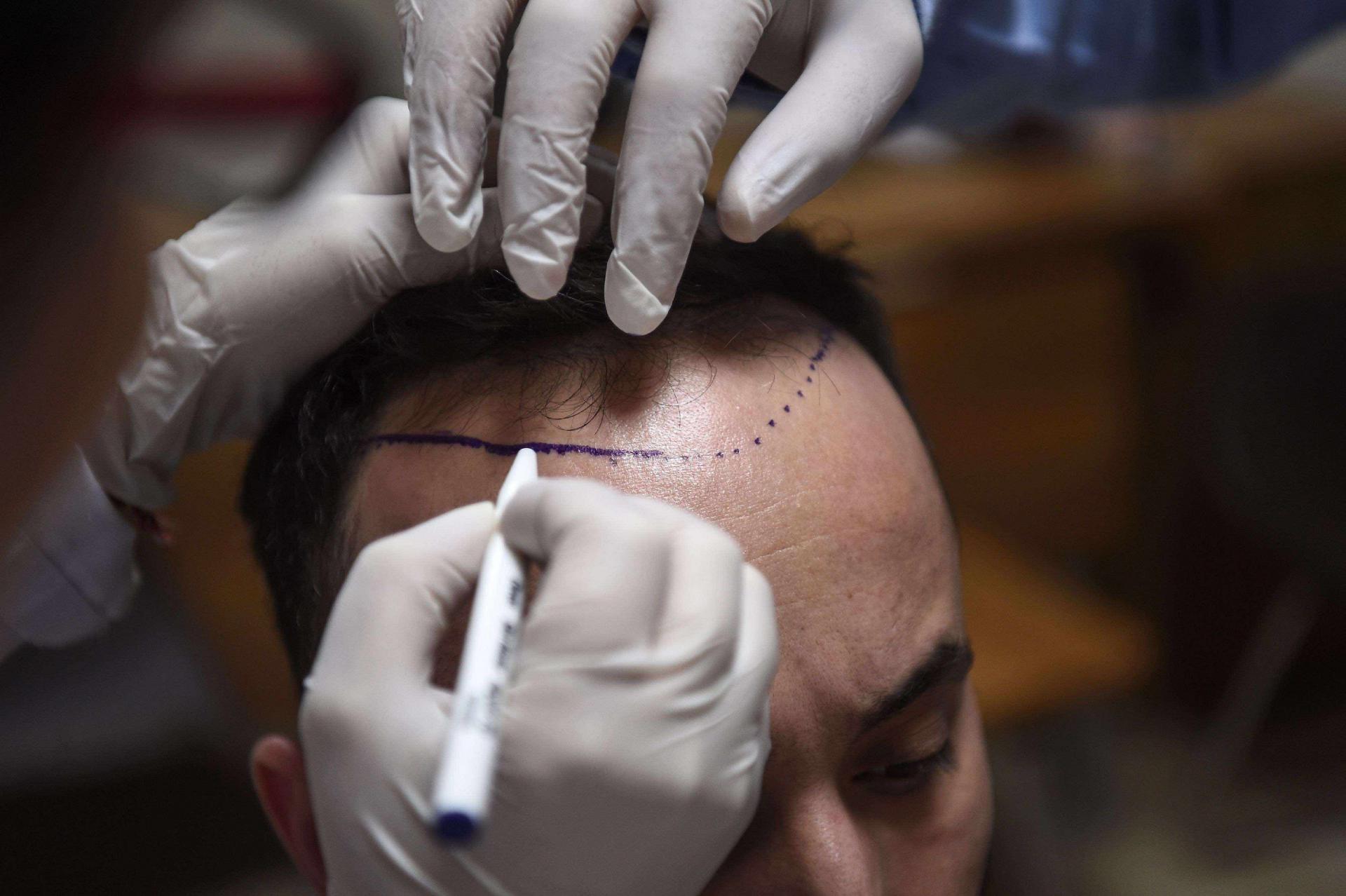 A hair specialist checks a patient in Istanbul