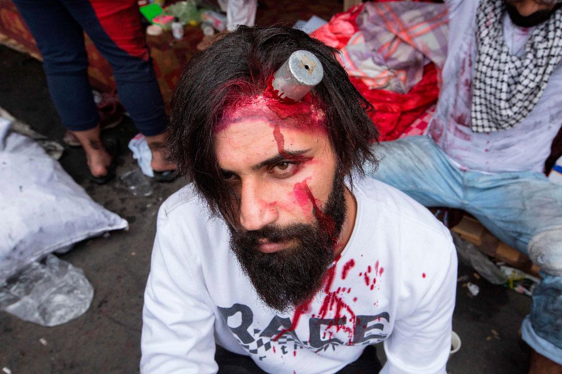 An Iraqi actor playing an injured anti-government protester with a tear gas canister lodged in his head