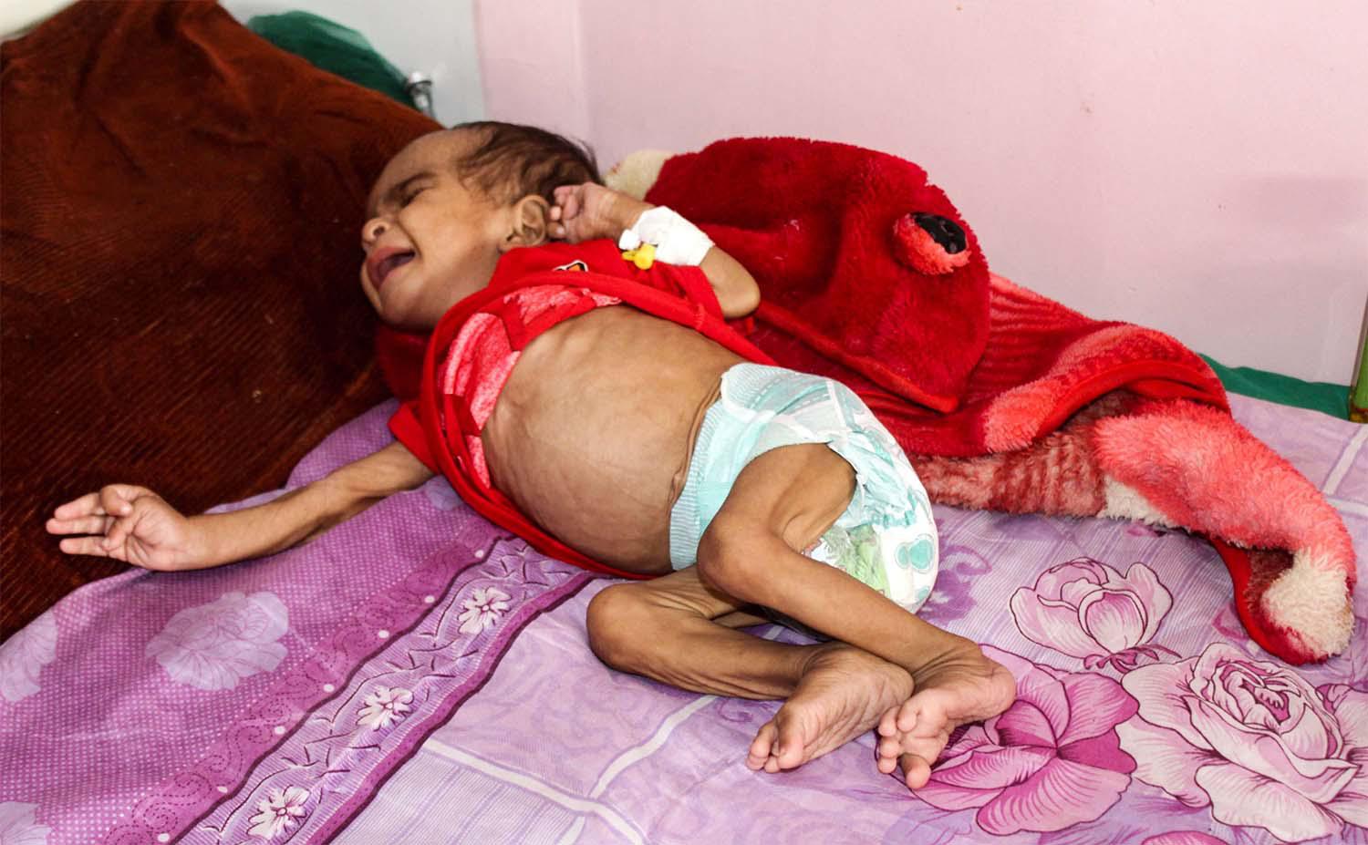 120,000 children are severely malnourished