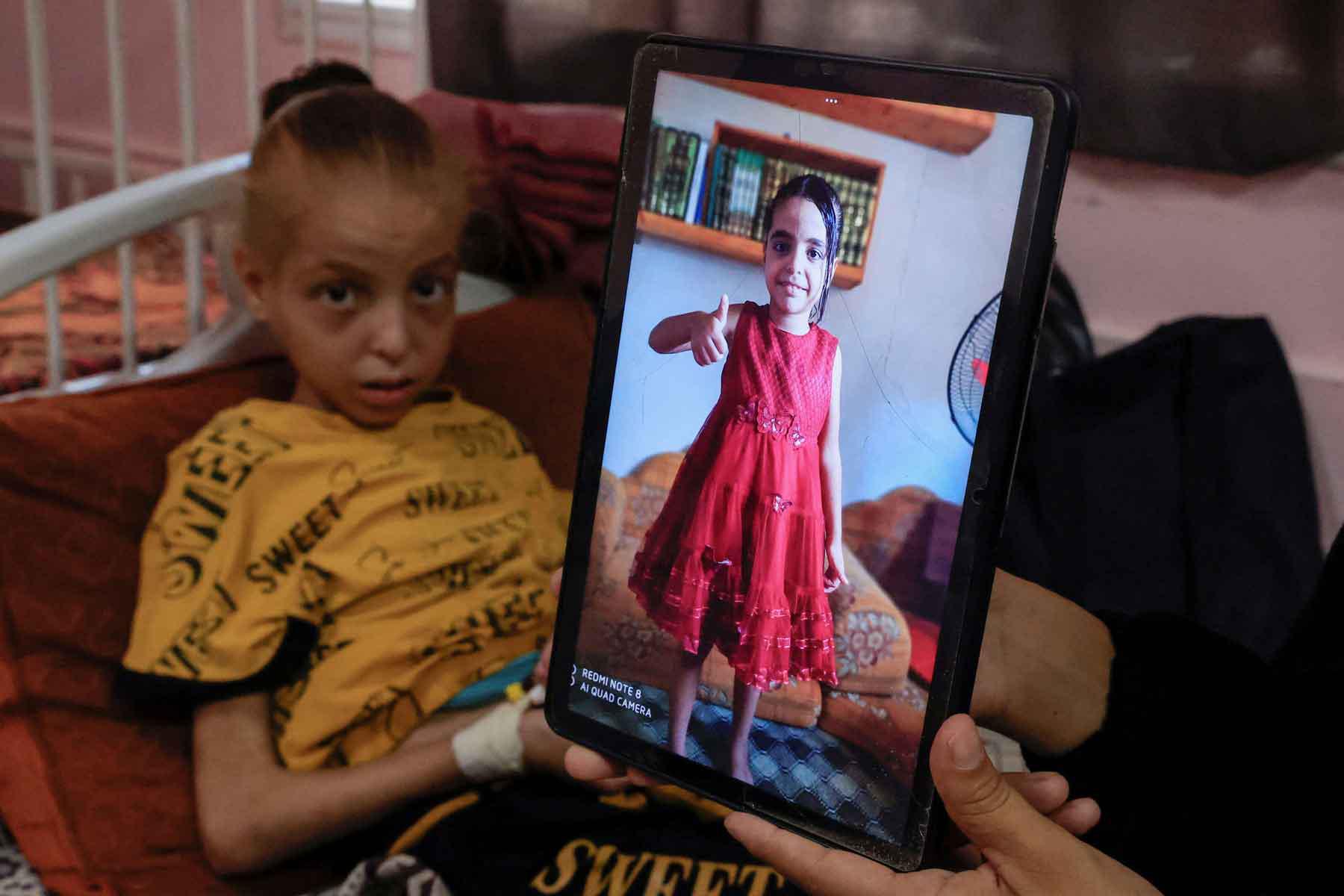 A Palestinian girl lies on a bed receiving treatment at the malnutrition ward at Nasser hospital, in Khan Younis, southern Gaza Strip, August 5, 2025. 